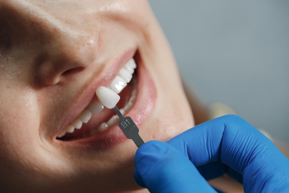 Veneerler Nedir?